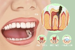 牙齿中间有黑洞，很可能是死髓牙！